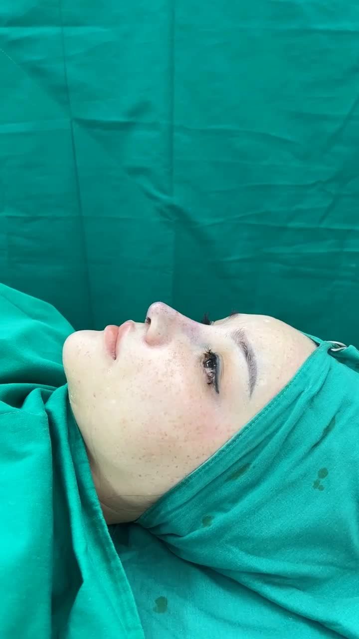 Case mũi Cấu trúc sửa lại sụn surgiform vừa hoàn thành