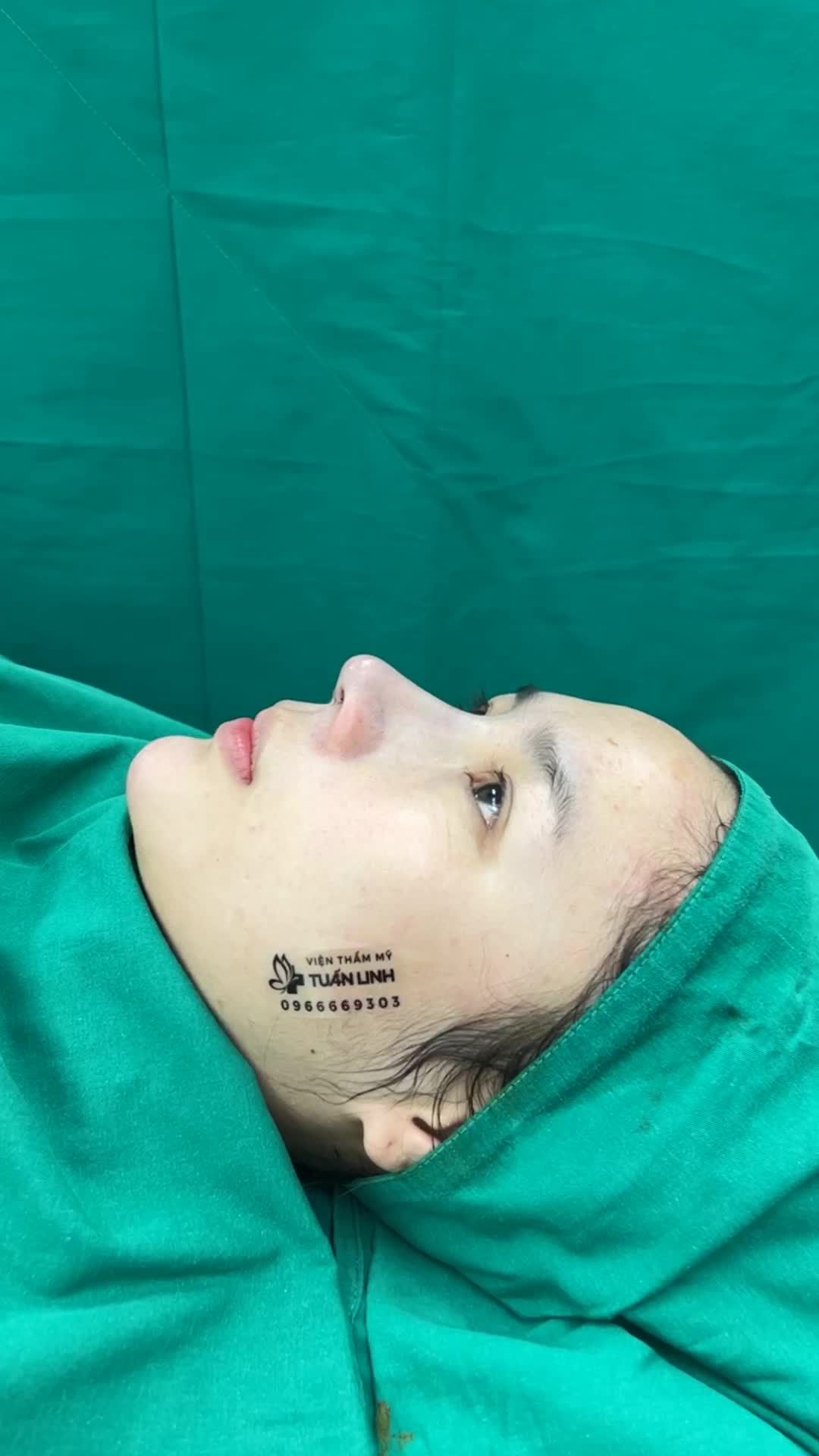 FORM MŨI TRUNG HOA CHO CÔ GÁI ĐẾN TỪ QUẬN 3