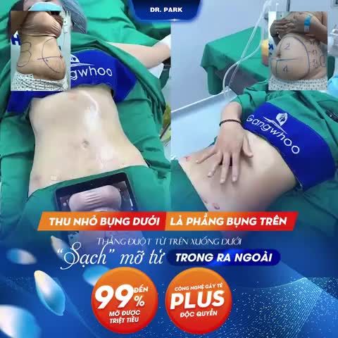 HÚT MỠ THẾ HỆ MỚI - LIPO ULTRASOUND có gì khác biệt