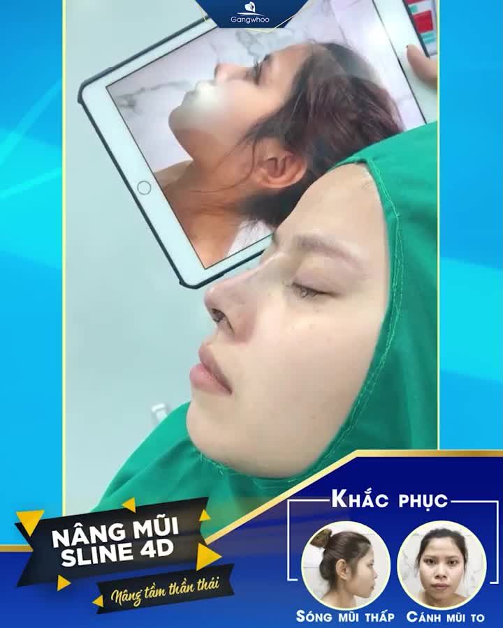 VÌ SAO NGÀY NAY 100 NGƯỜI THÌ 90 NGƯỜI CHỌN NÂNG MŨI CẤU TRÚC