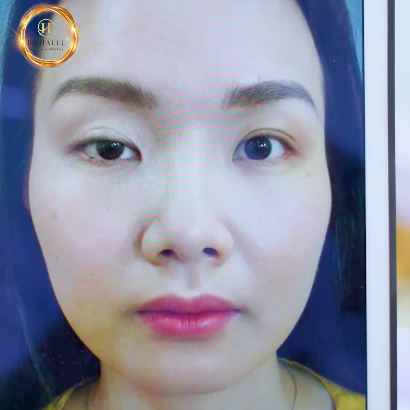 Bạn ấy đã khóc khi nhìn thấy kết quả Phẫu thuật chỉnh hình mí sụp bẩm sinh tại Dr.Hải Lê.