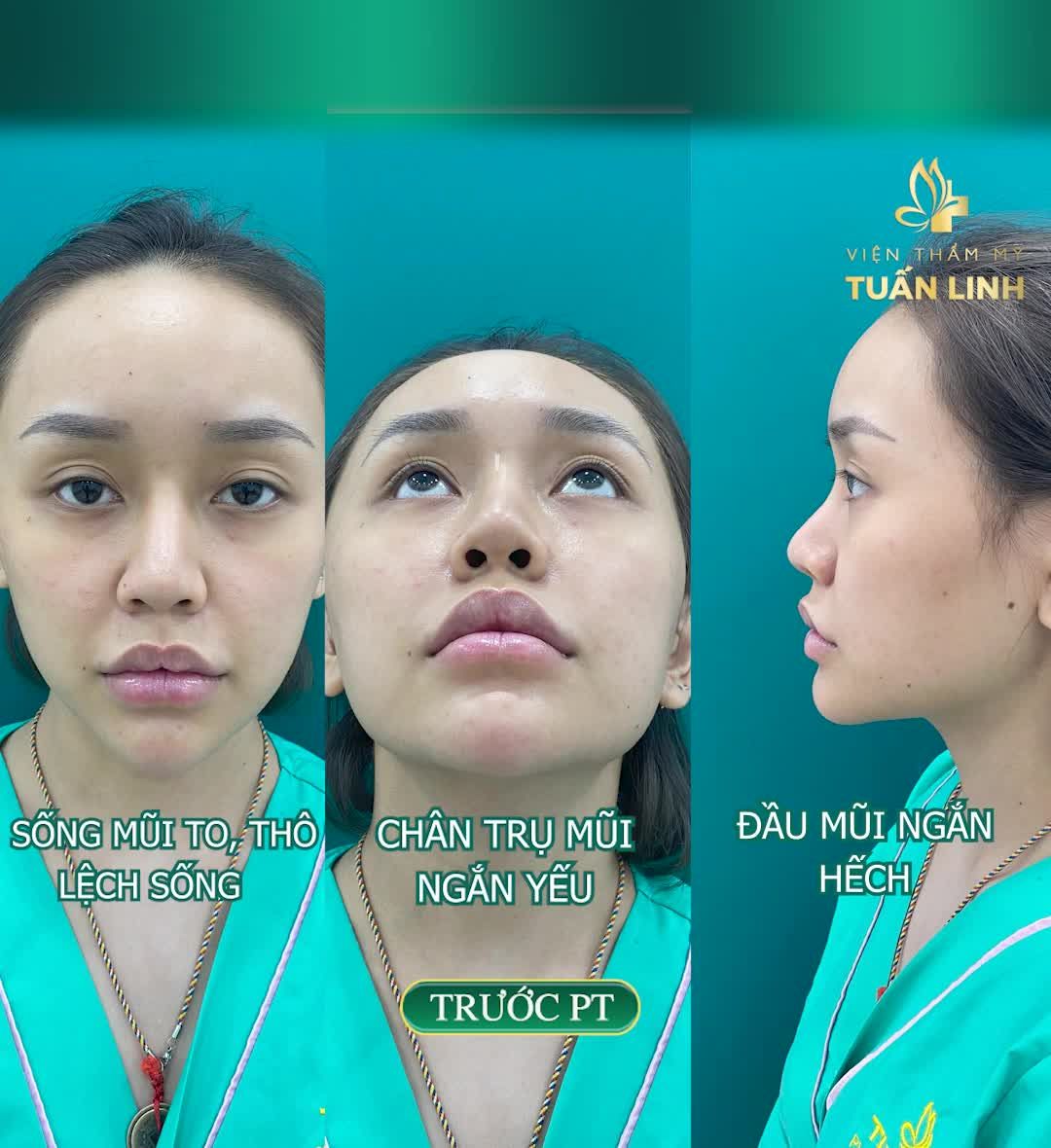 Khách hàng đến với Tuấn Linh trong tình trang mũi đã từng nâng bọc sụn nhưng dáng mũi không đẹp.