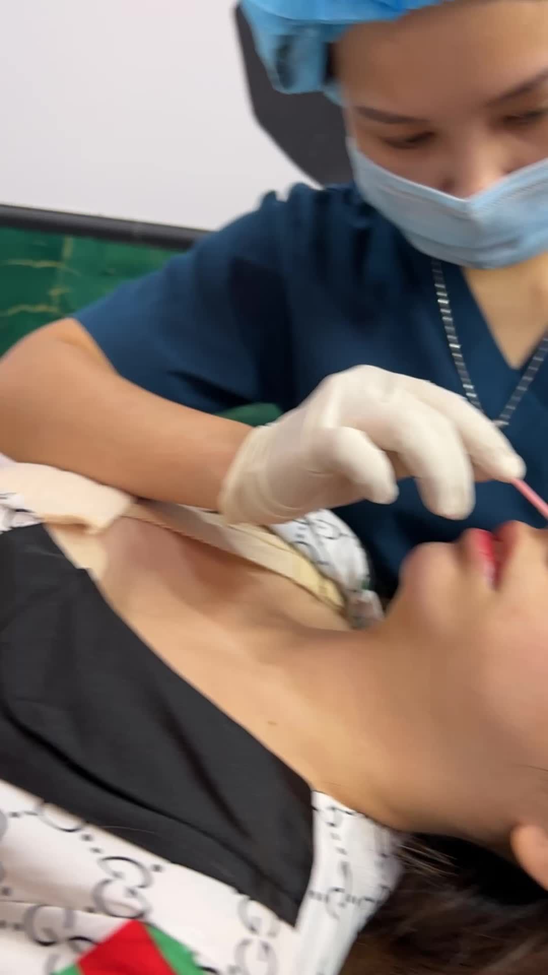 Khách hàng làm combo nâng V1 + Nâng mũi + cuộn cánh mũi được 5 ngày, bạn đến Viện vệ sinh và thay nẹp