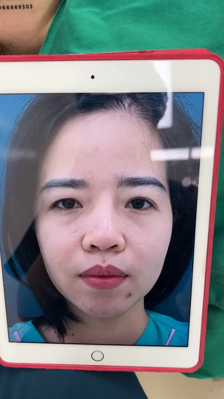 Case mũi cấu trúc sửa lại vừa hoàn thành