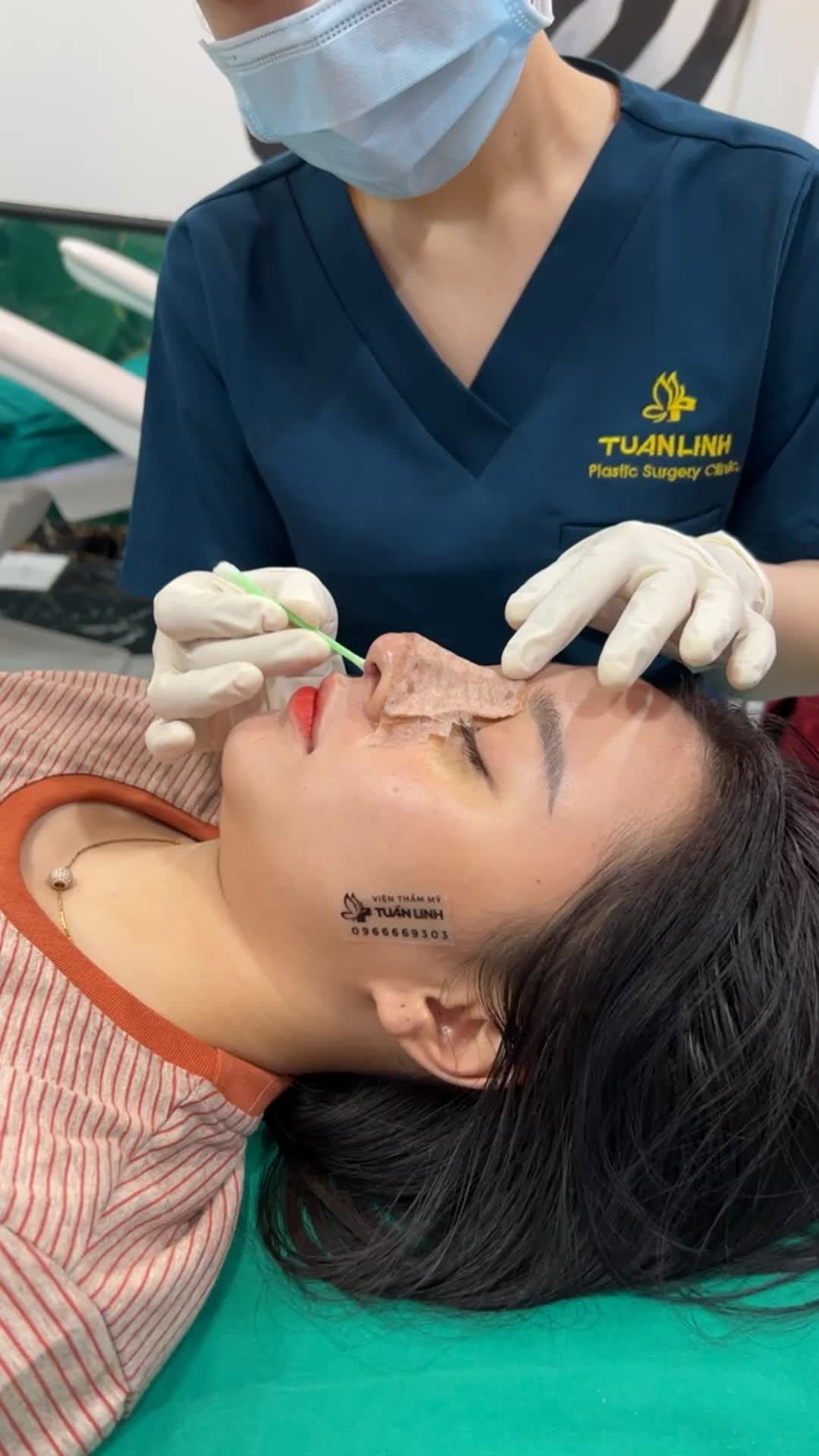 Chiếc mũi siêu cấu trúc Surgiform sau 5 ngày thay nẹp!!!