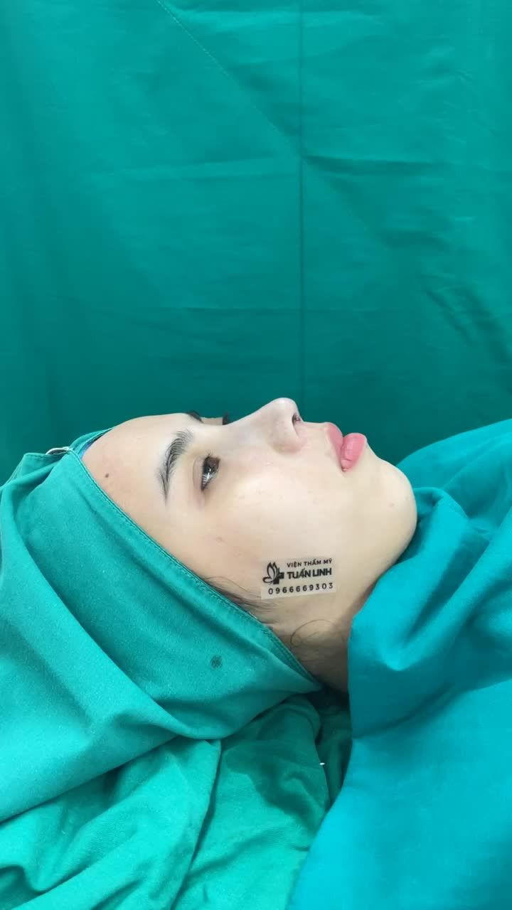 Phương pháp nâng mũi siêu cấu trúc sụn tai