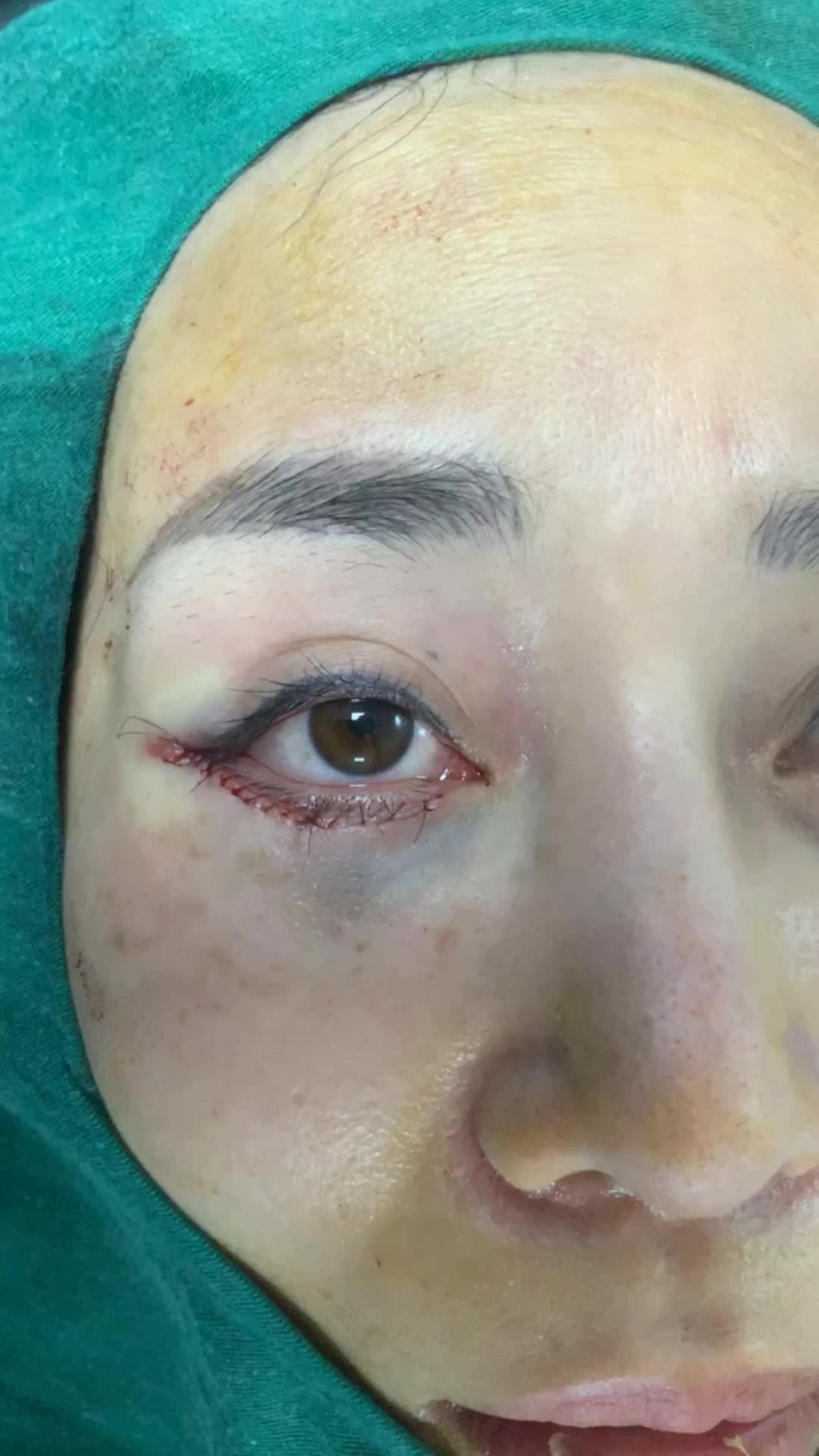 Combo xoá rãnh lệ sâu tạo mắt to + hạ xếch !