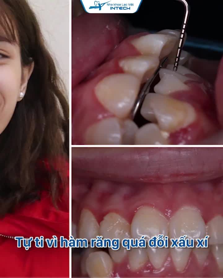 KHÔNG DÁM CƯỜI VÌ HÀM RĂNG ĐÁNH NHAU VÀ 20 THÁNG THAY ĐỔI CUỘC ĐỜI