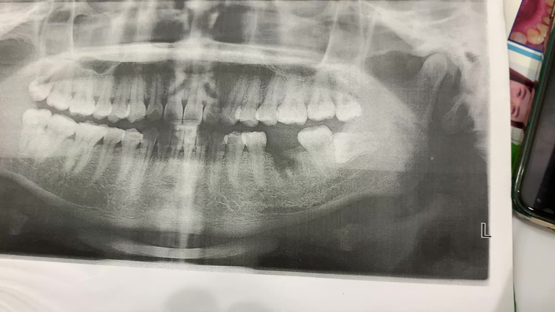 Lắp răng implant khôi phục răng 6 bị mất cho khách hàng