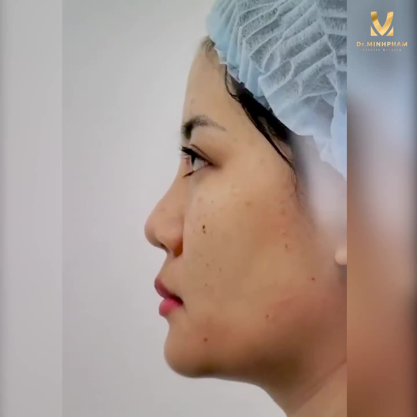 Mũi đẹp bất ngờ - Chi phí như mơ