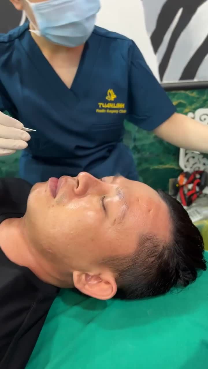 Nâng mũi bọc sụn tái khám, cắt chỉ sau 10 ngày!