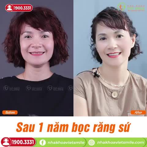 CẢM NHẬN SAU 1 NĂM BỌC RĂNG SỨ THẨM MỸ