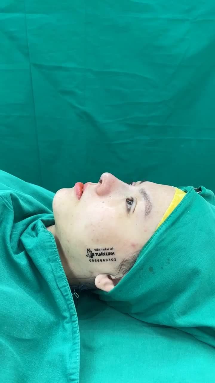 Case mũi Siêu cấu trúc sụn surgiform + nhấn mí cho bạn gái đến từ Vũng Tàu