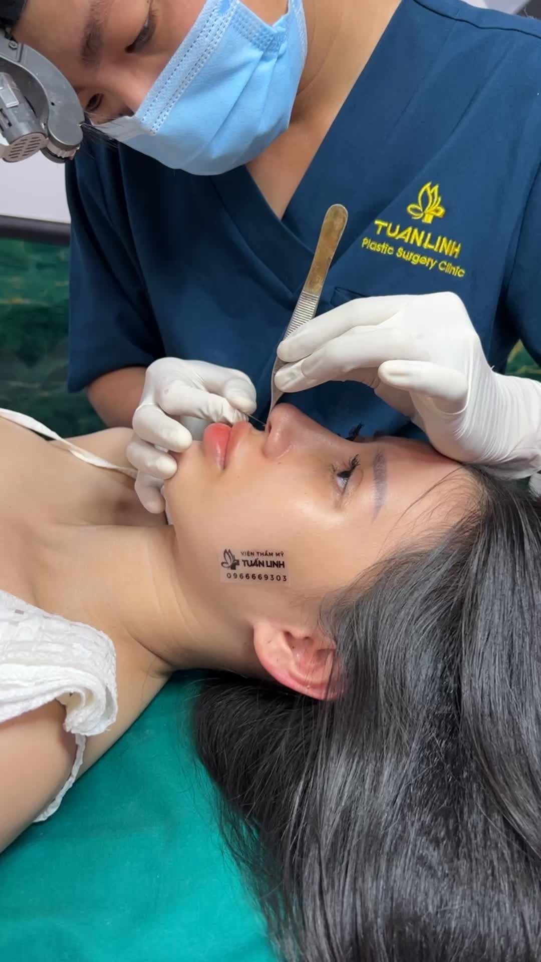 Khoe ''nhẹ'' chiếc mũi xinh xắn sau 10 ngày nâng cấu trúc tại Tuấn Linh !!!