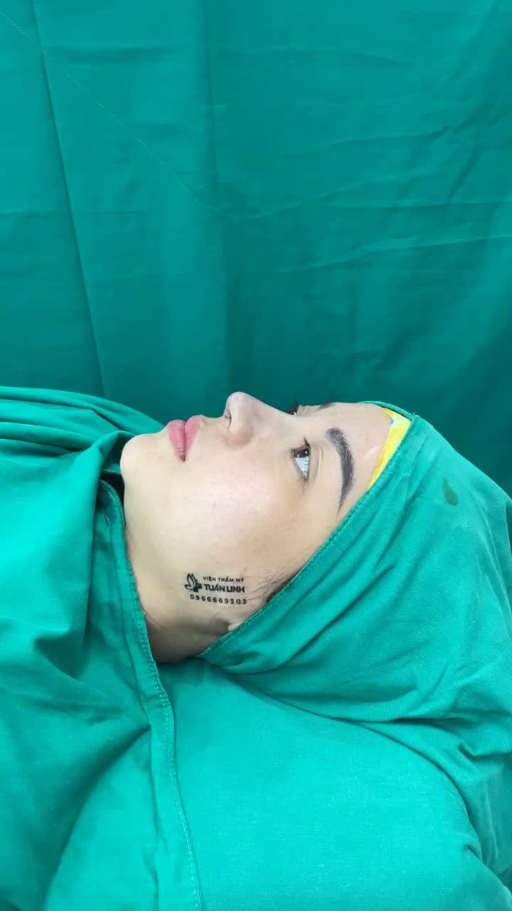 Sở hữu ngay dáng mũi cao tây, đầu mũi bay thanh tú chỉ sau 90 phút phẫu thuật