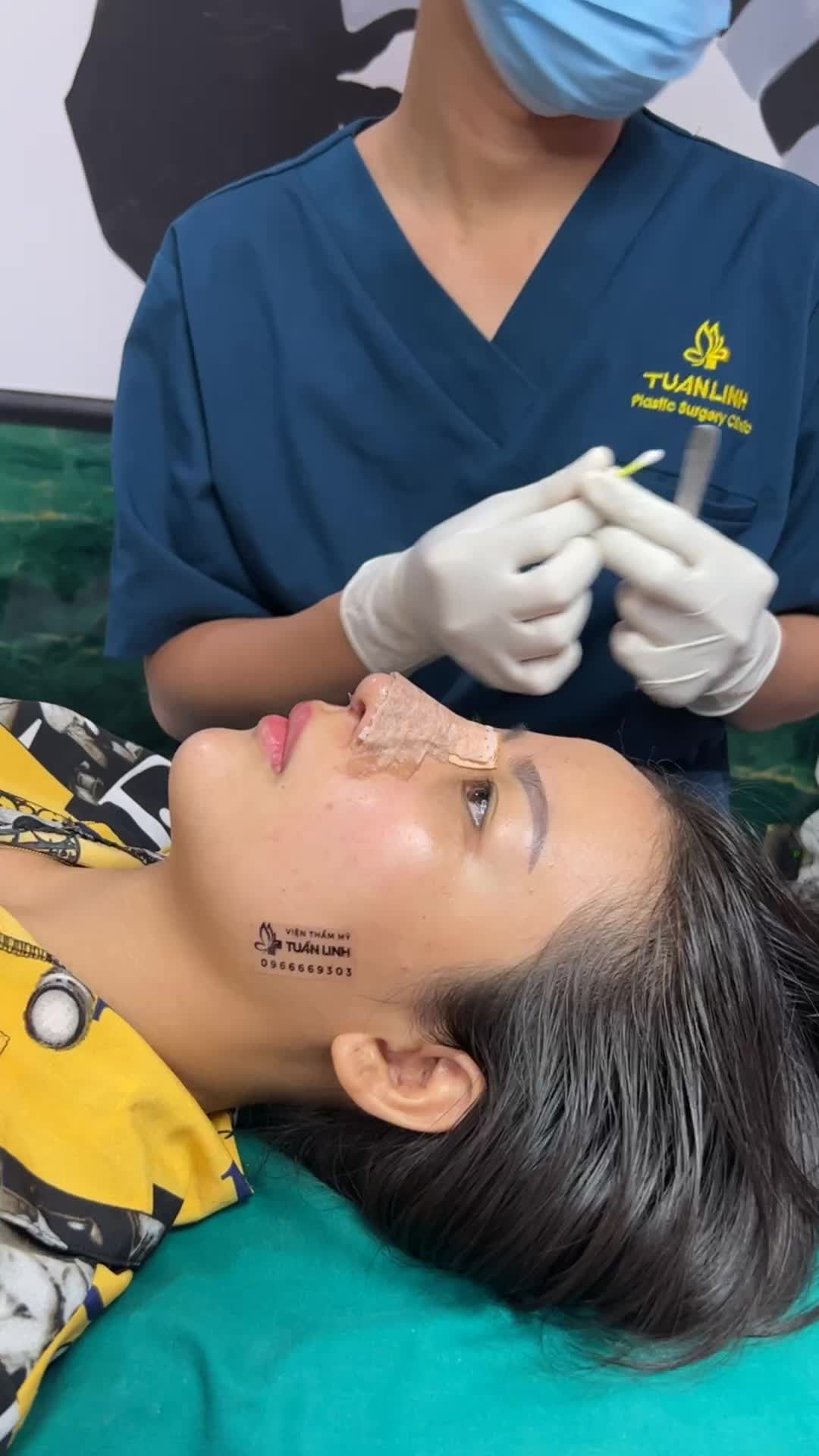 Cận cảnh case nâng mũi tái cấu trúc phức tạp + Độn cằm sau 10  ngày tháo nẹp, tái khám!