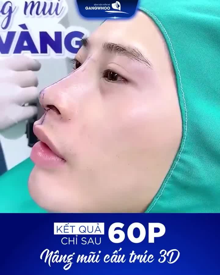CÓ NÊN NÂNG MŨI SỤN TAI SINH HỌC