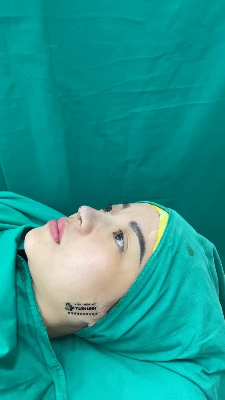 Sở hữu ngay dáng mũi cao tây, đầu mũi bay thanh tú chỉ sau 90 phút phẫu thuật