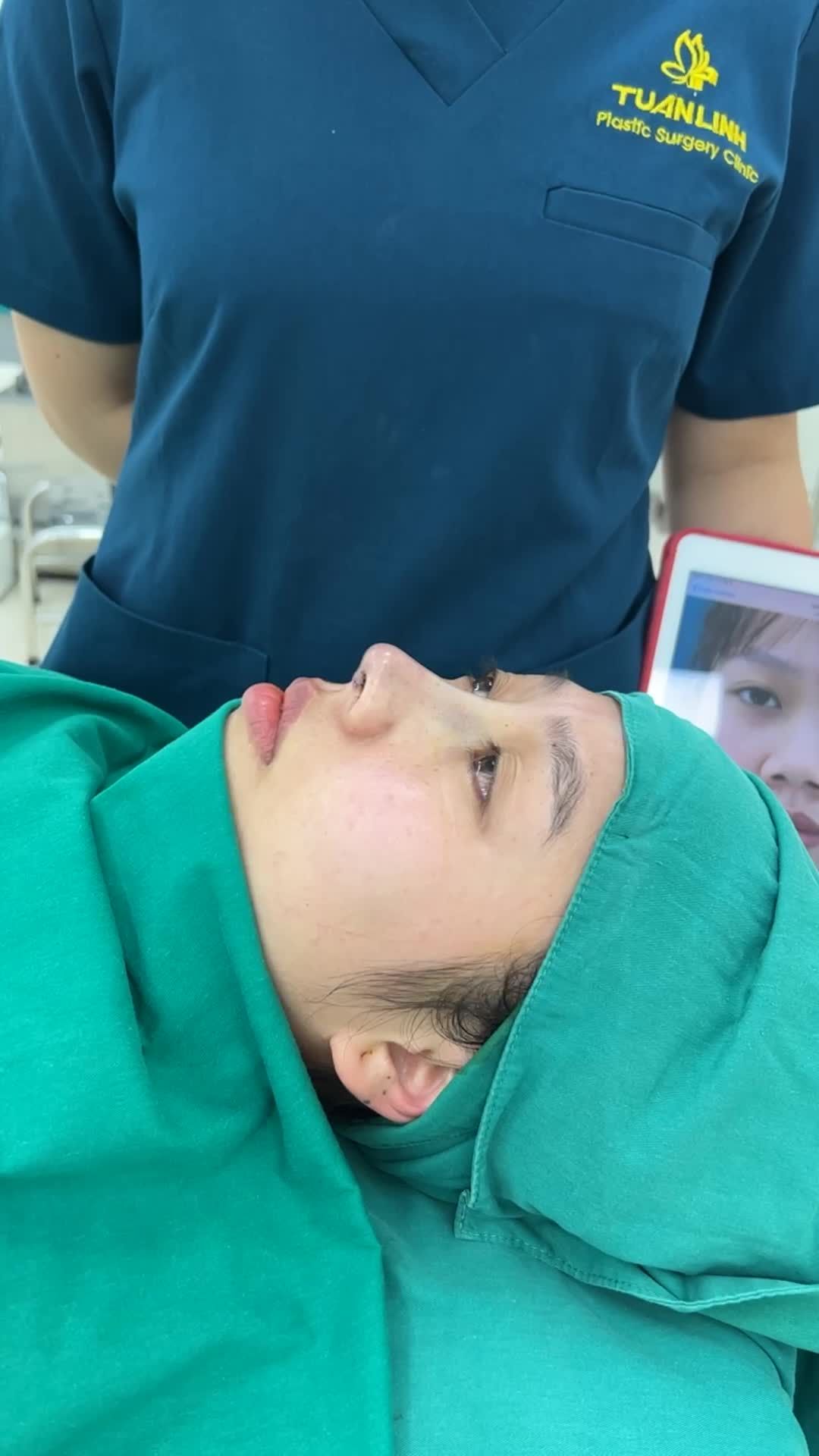 Case nâng mũi siêu cấu trúc Surgiform cho bạn gái đến từ Đà Lạt.
