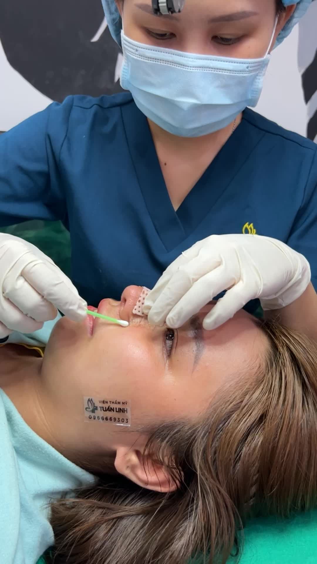 Cắt chỉ và tái khám cho bé Vân Anh nâng mũi cấu trúc được 10 ngày