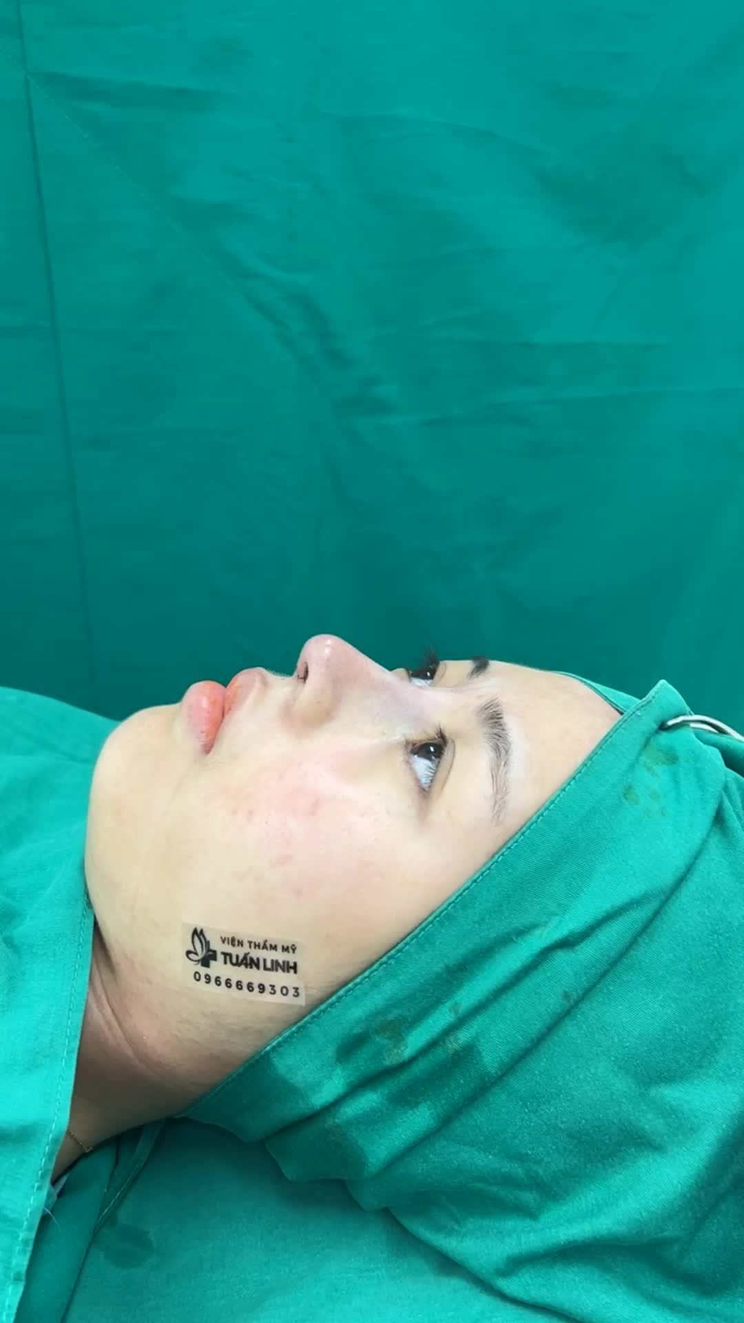 Tạo hình dáng mũi cao tự nhiên cho bạn gái đến từ Vĩnh Long