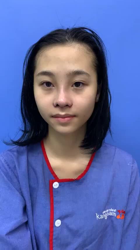 Nâng mũi + Cắt cánh Đẹp ngay sau làm