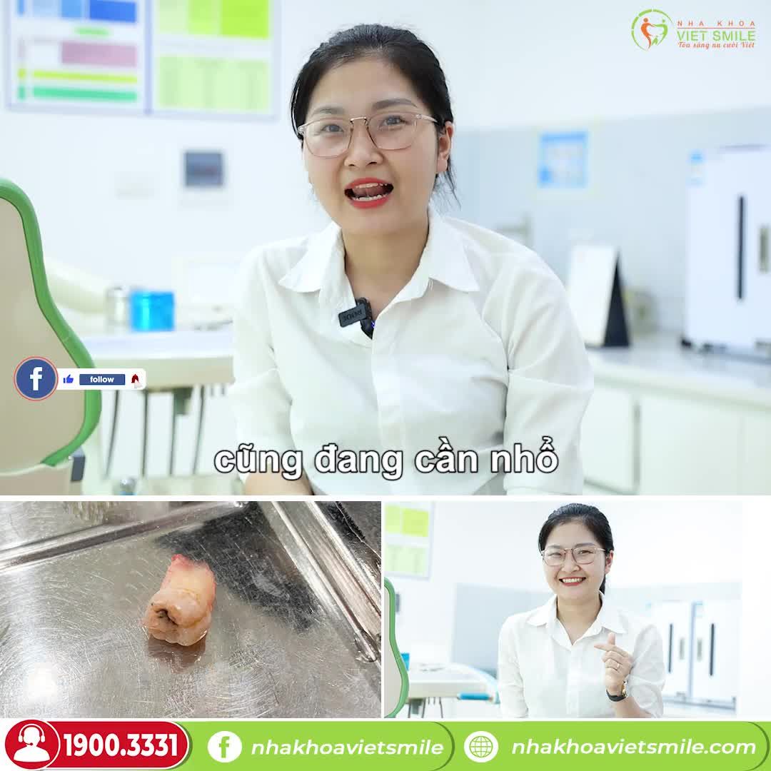 NHỔ RĂNG KHÔN LỢI TRÙM KHÓ VỆ SINH GÂY SÂU VÀO TỦY