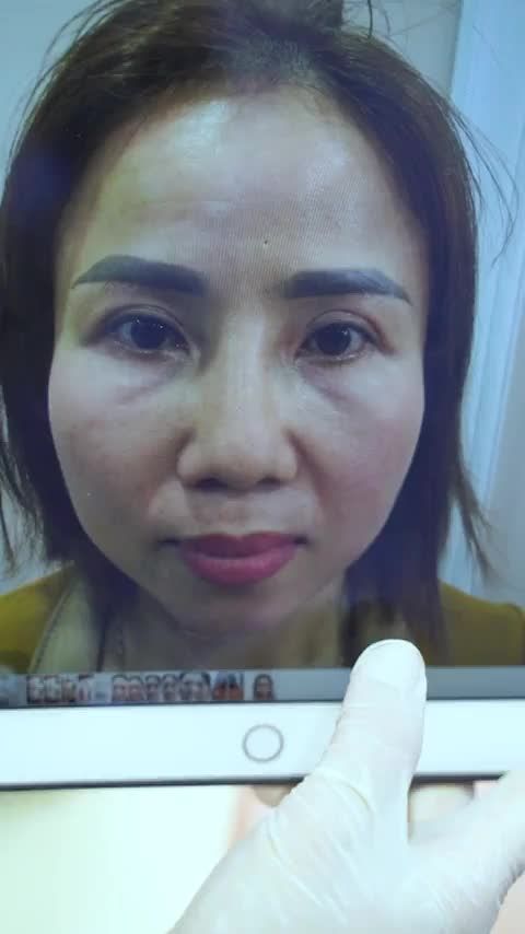 Xóa tan rãnh mũi má sâu gây cho bạn sự già nua hốc hác chỉ sau 5 phút