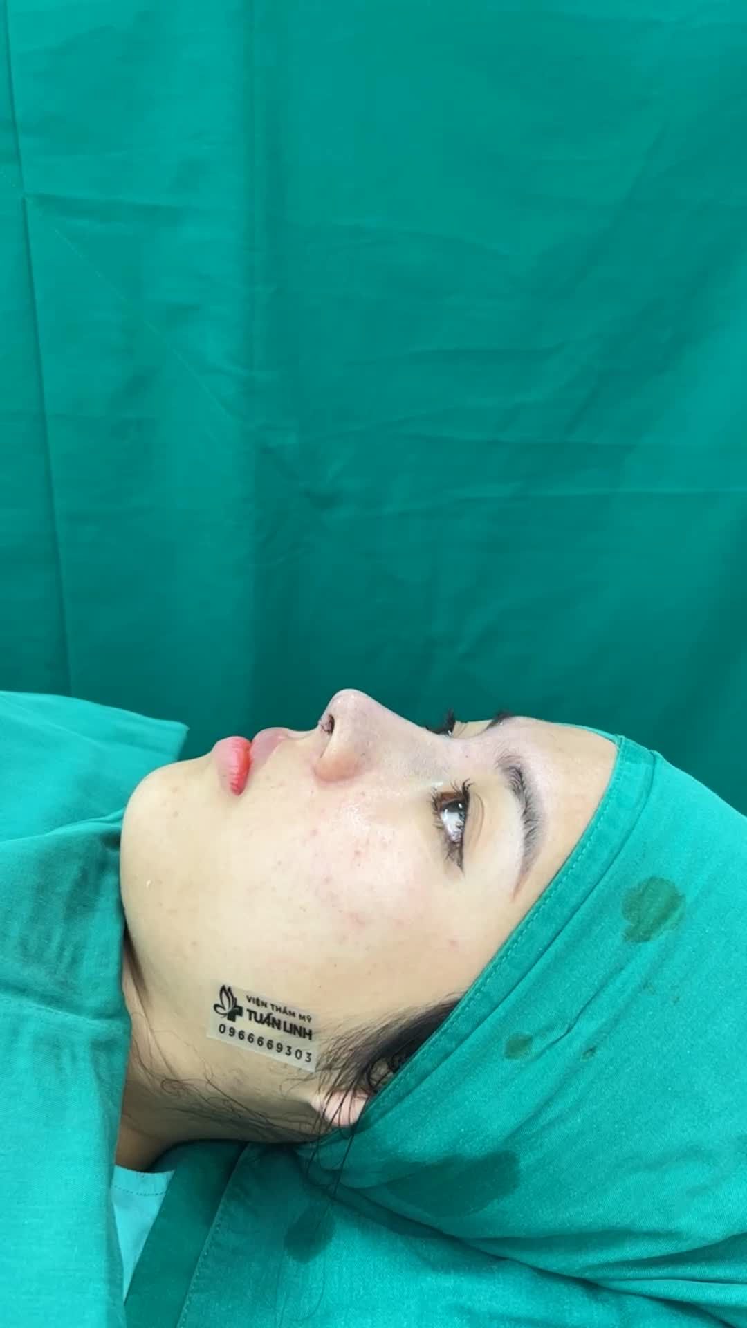 Khắc phục đầu mũi to, sống mũi thấp gẫy nhiều