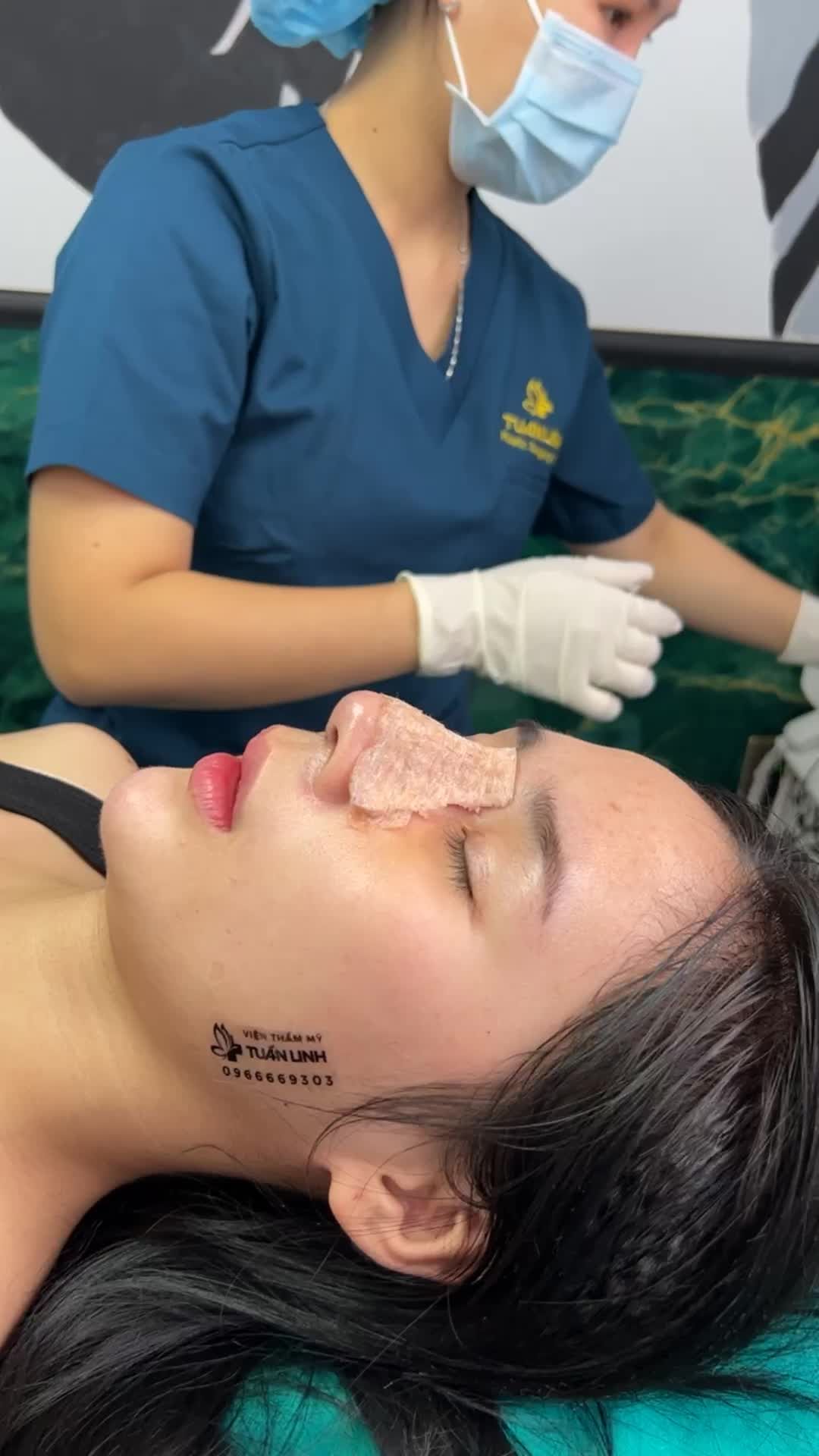 Thay nẹp sau 7 ngày nâng mũi cấu trúc