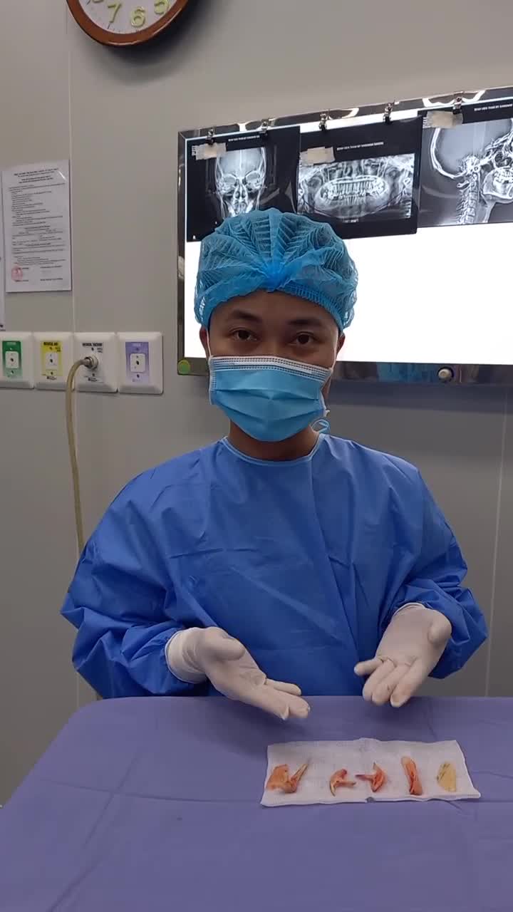 Có ai như admin, xem phần xương hàm mặt được cắ.t bỏ thấy đã quá trời!