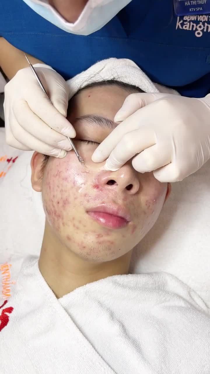 Công nghệ điều trị mụn DE-ACNE siêu việt tại Kangnam .