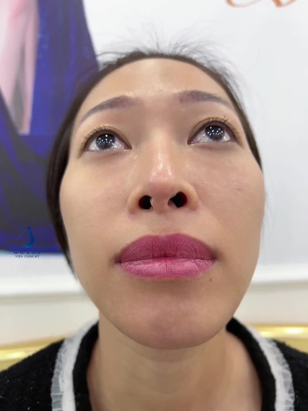 Mũi tái cấu trúc, sụn Surgiform