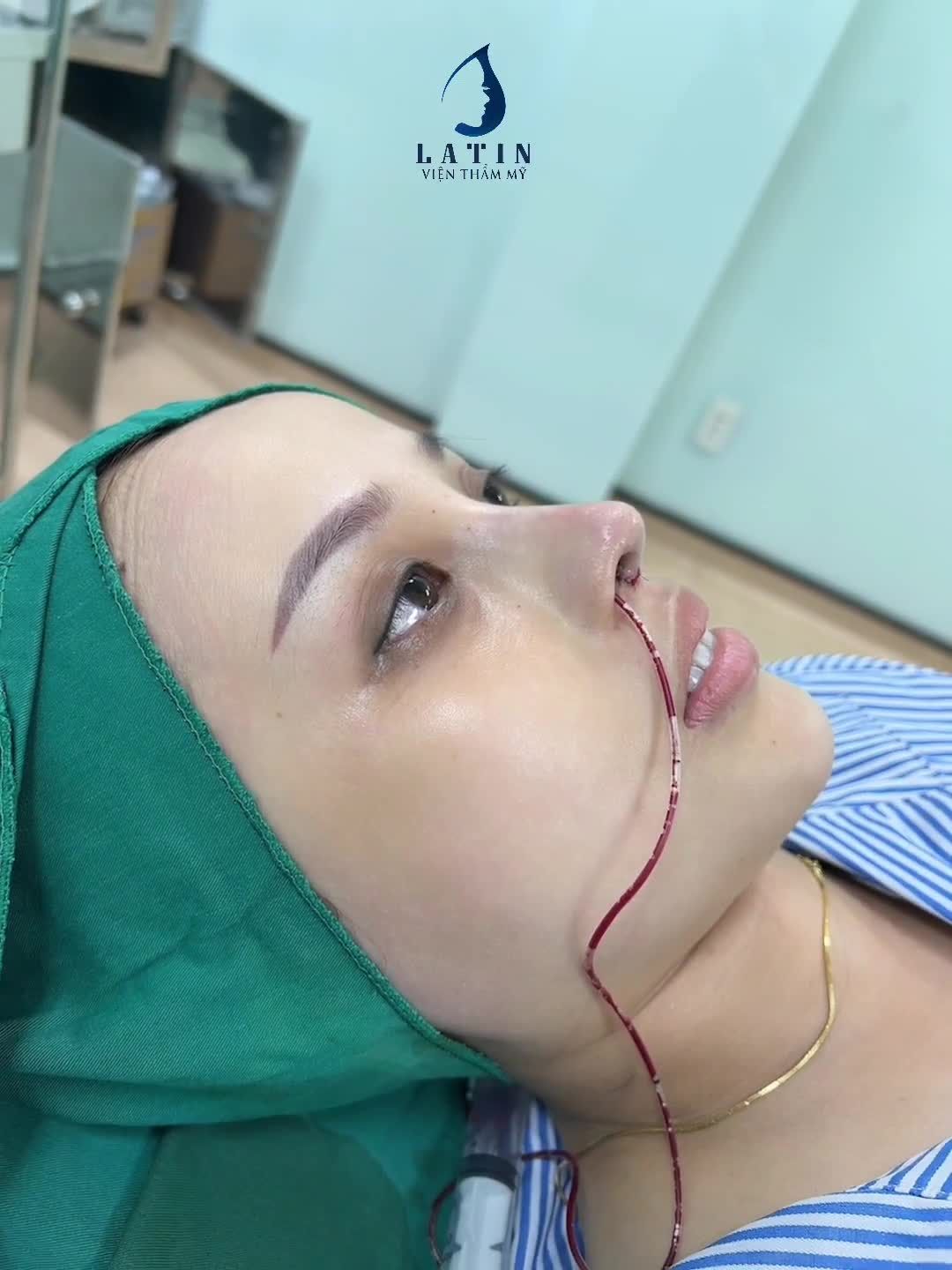 Mũi nâng 6 năm sửa lại có đẹp không