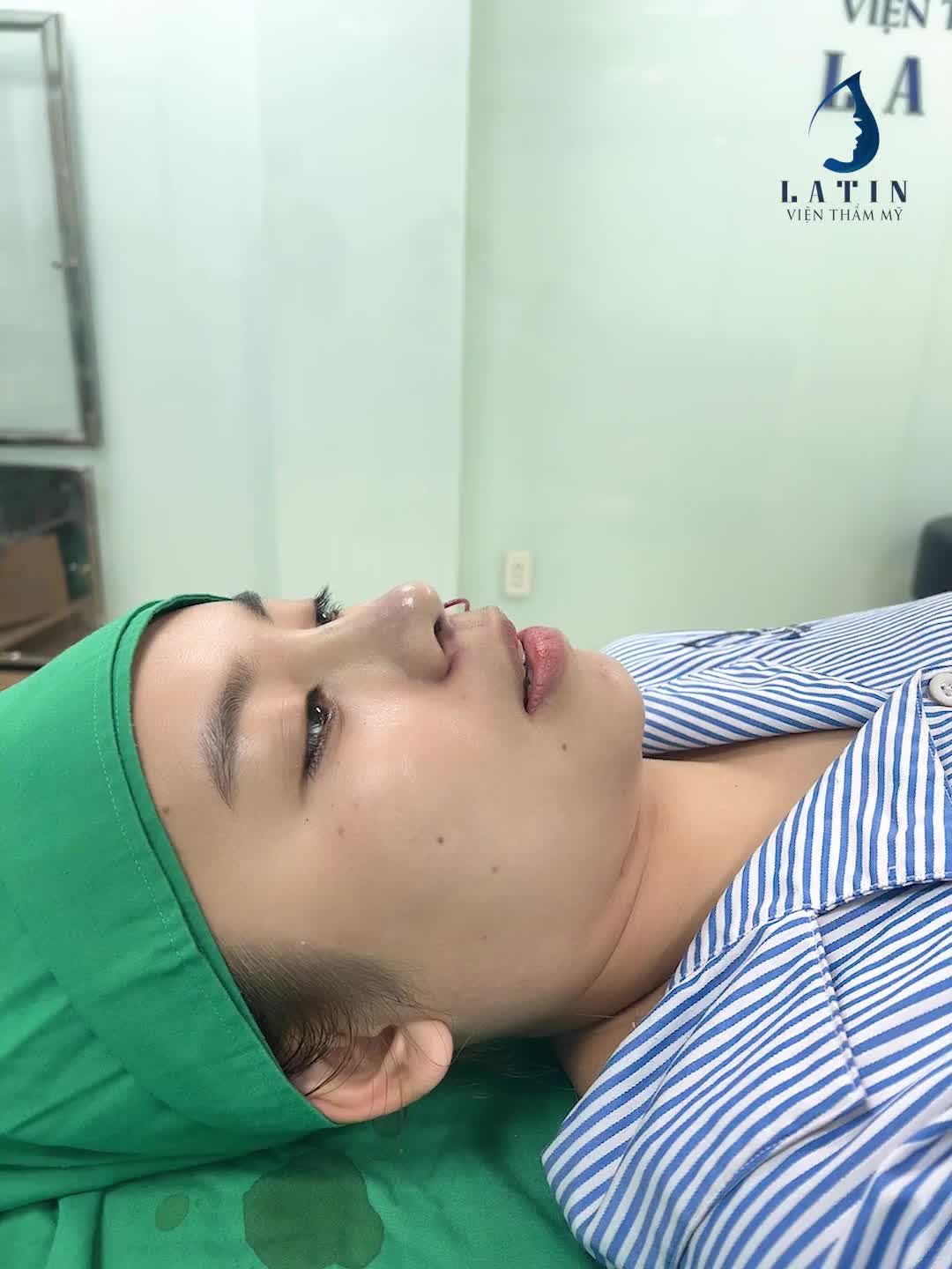 Mũi bán cấu trúc cho em gái lần đầu tiên nâng mũi