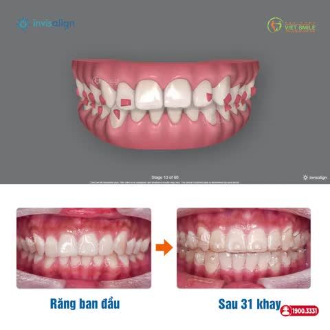 SO SÁNH THỰC TẾ & CLINCHECK INVISALIGN RĂNG CHEN CHÚC