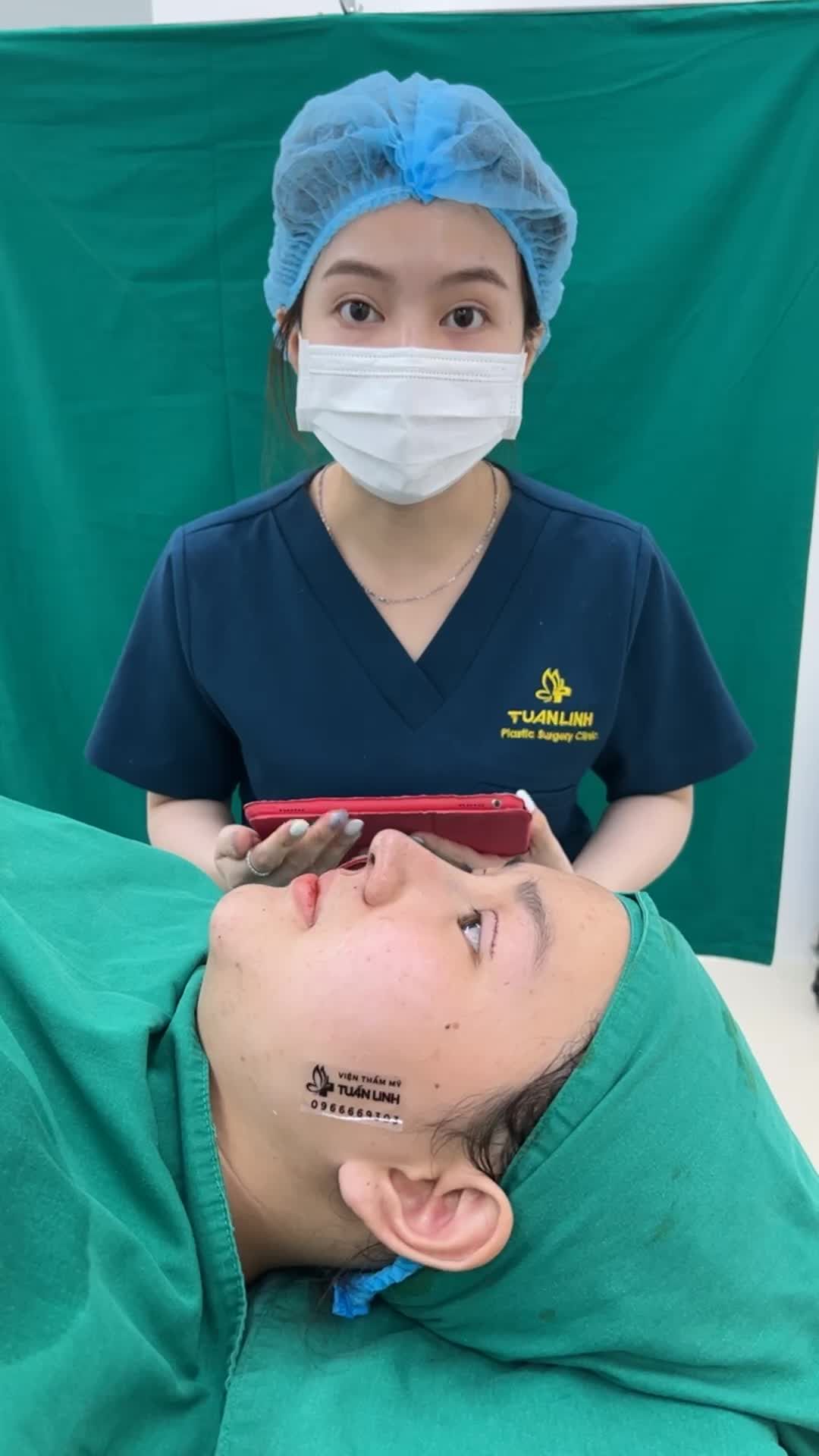Mũi cao sang chảnh- Mí đẹp, không sưng bầm, tự nhiên ngay sau phẫu thuật