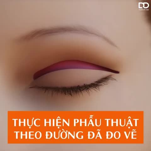 CẬN CẢNH PHẪU THUẬT CẮT MÍ CHUẨN Y KHOA TẠI DRD