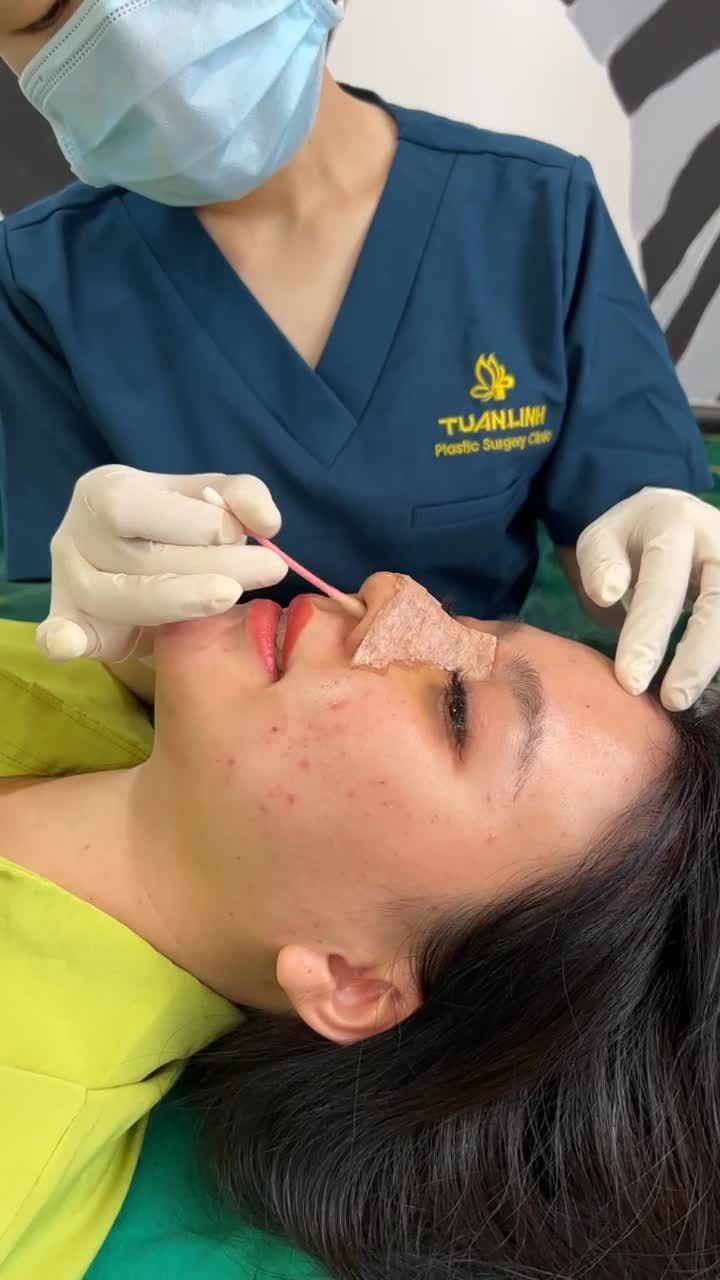 Case Nâng mũi cấu trúc sụn surgiform được 5 ngày thay nẹp!!!