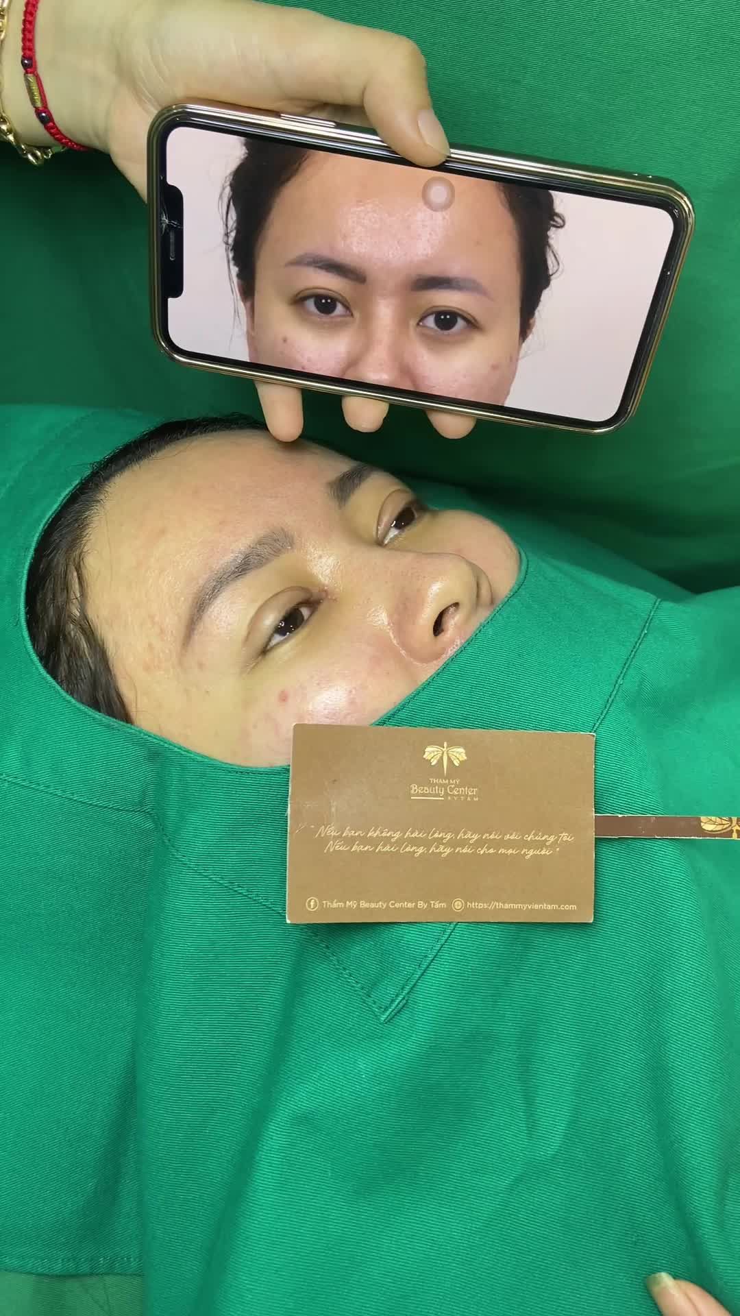 Thay đổi nhưng vẫn cực tự nhiên sau khi Cắt mí Mở góc trong.