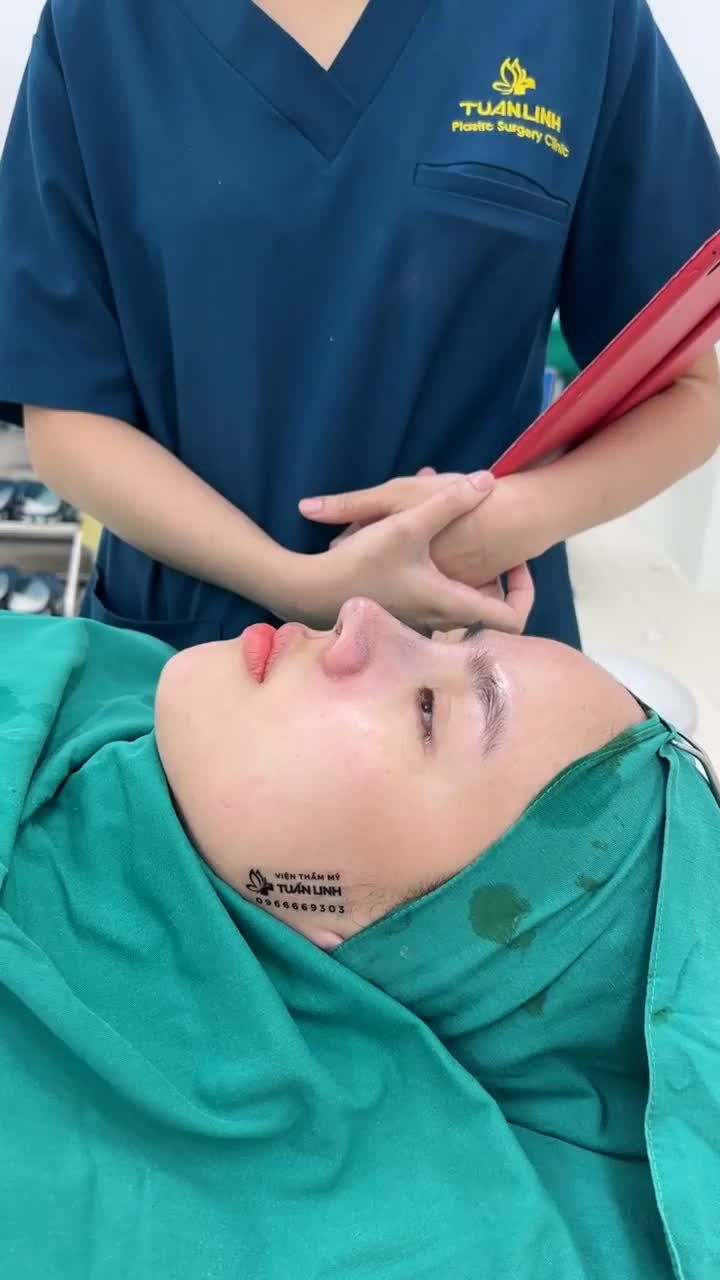KẾT QUẢ SAU 90 PHÚT THỰC HIỆN NÂNG MŨI AN TOÀN