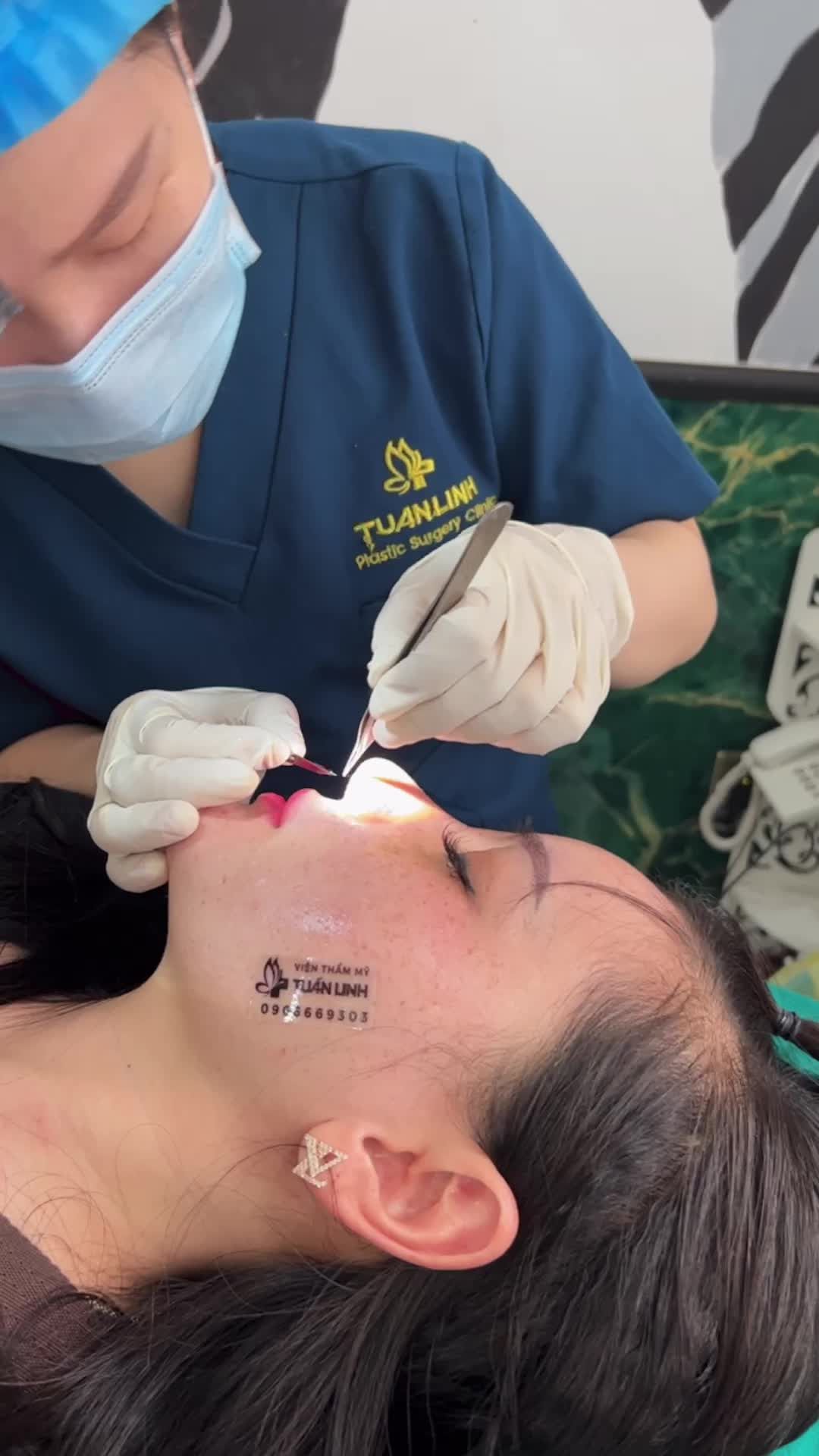 Tháo nẹp và cắt chỉ cho khách hàng nâng mũi Siêu cấu trúc sửa lại sụn Surgiform được 10 ngày