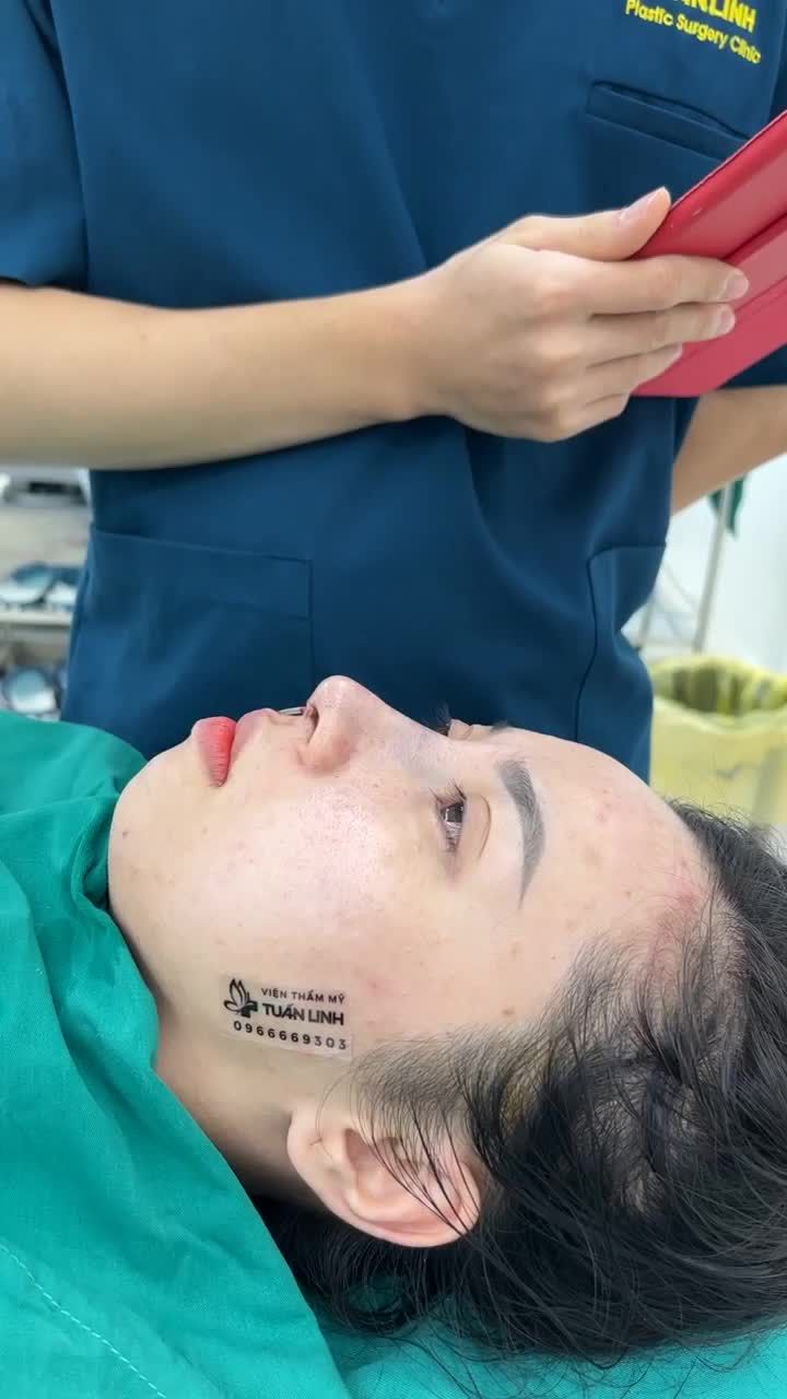 Case nâng mũi cấu trúc vừa hoàn thành sau 90 phút cho bé gái đến từ Bình Phước