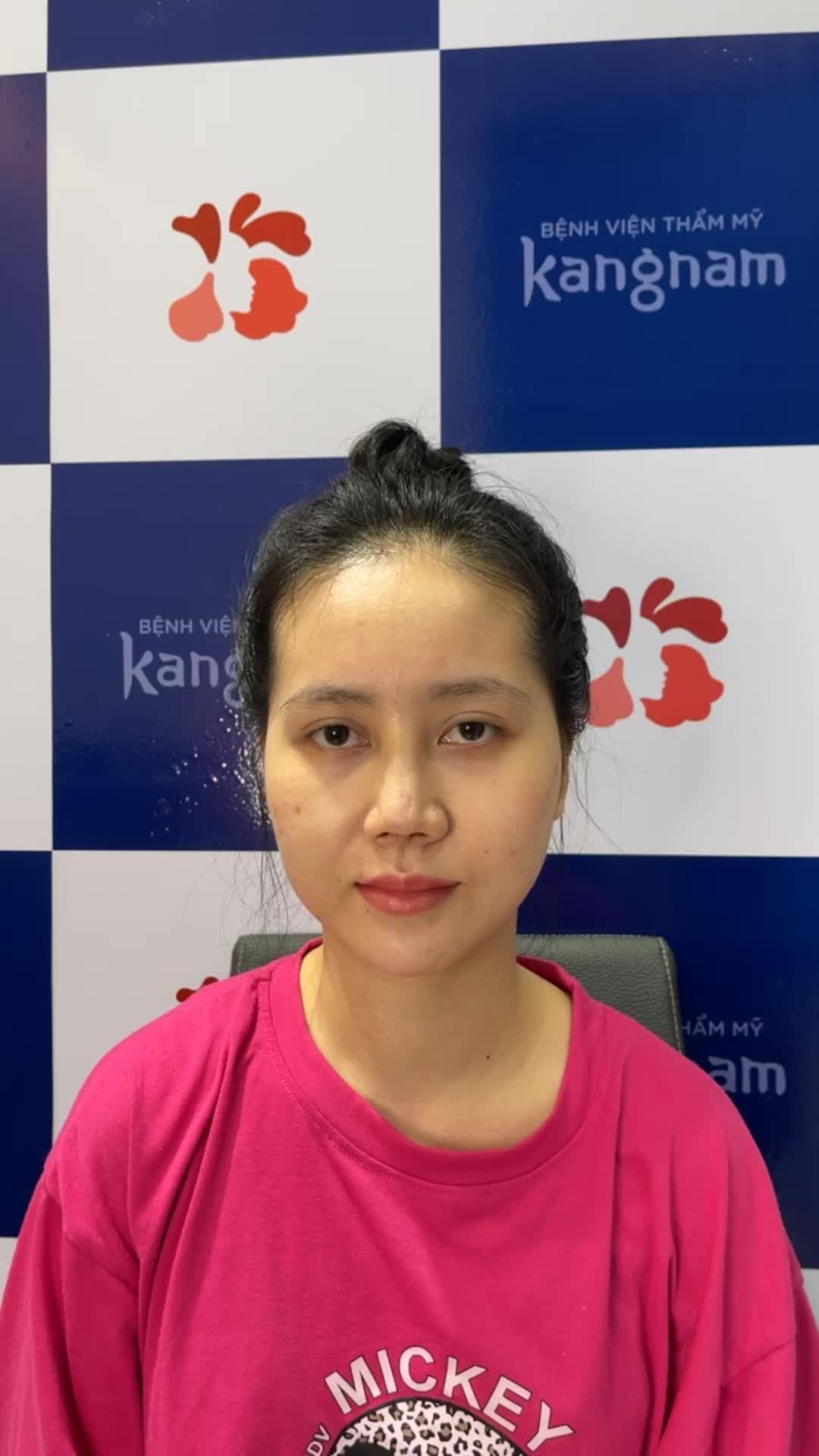 Một trong rất nhiều khách hàng phải tới Kangnam sửa lại mũi  Vui mừng chia sẻ hình ảnh sau khi thực hiện được 1 tháng