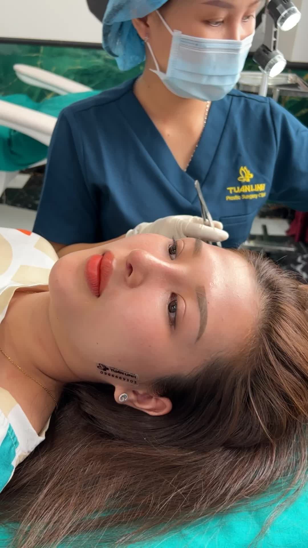 Dáng mũi sau 10 ngày vào phom đẹp tự nhiên