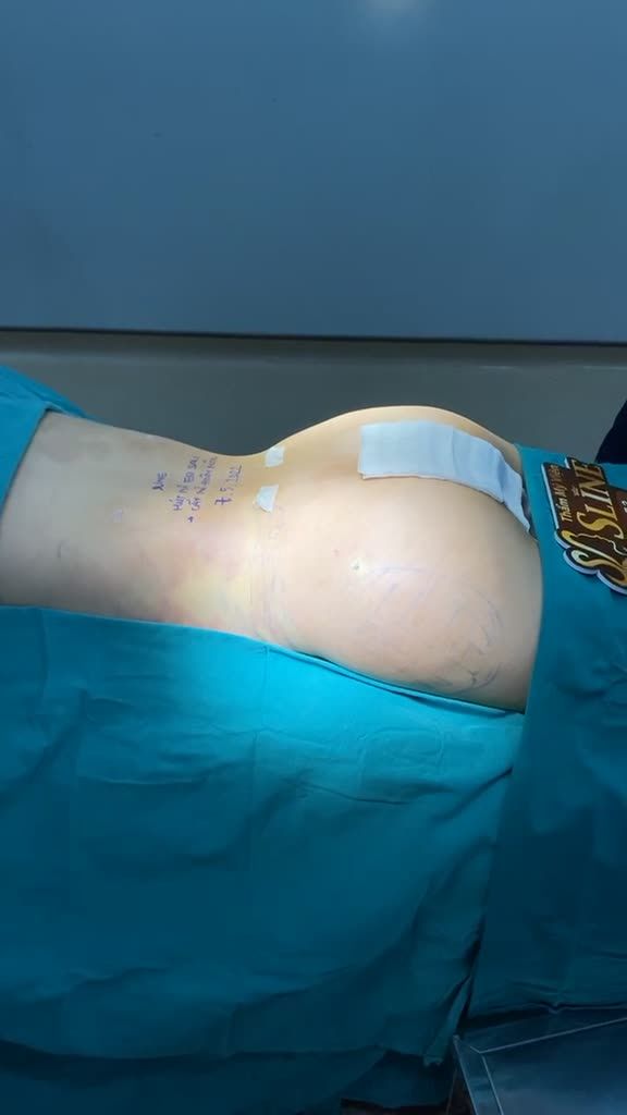KẾT QUẢ HÚT MỠ SIẾT EO + CẤY MỠ HÕM MÔNG