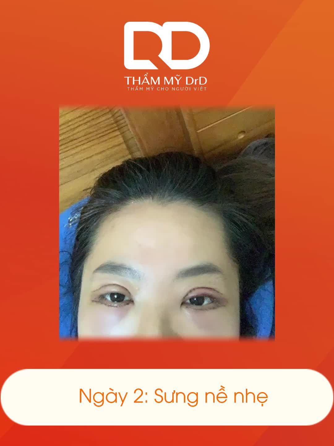 BÁC SĨ NHẬN THỬ THÁCH CẮT MÍ ELITE EYES VỚI TIÊU CHÍ 3 KHÔNG