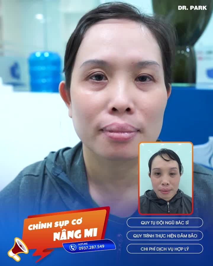 BỊ SỤP MÍ MẮT PHẢI LÀM SAO