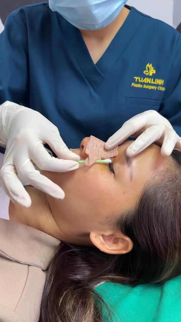 Case Nâng mũi Siêu cấu trúc sụn surgiform được 5 ngày - khách hàng đến vệ sinh và thay nẹp.