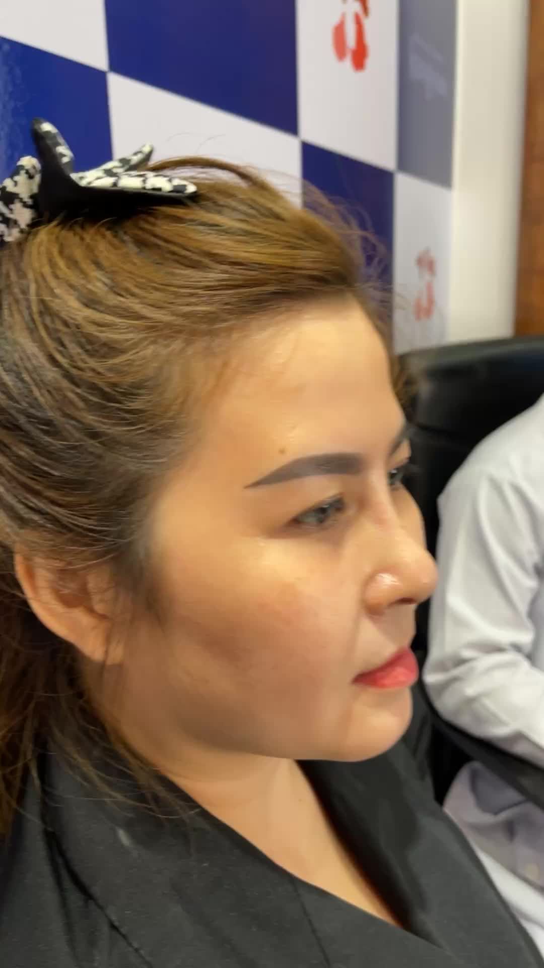 Nâng mũi cấu trúc 4d chỉ sau 10 ngày cắt chỉ Các chị em xem ngay livestream lấy động lực đi nâng mũi nào!!